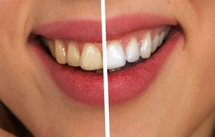 Snow Teeth Whitening Before After