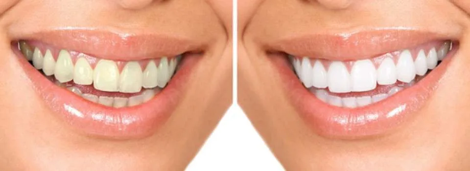 Snow Teeth Whitening Before After