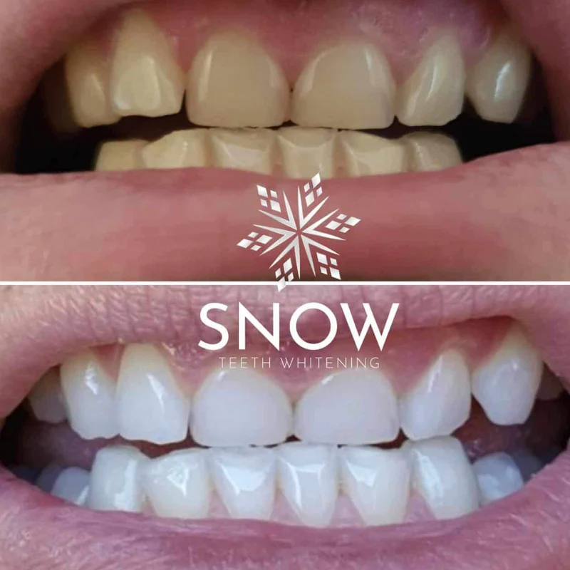 Snow Teeth Whitening Before After