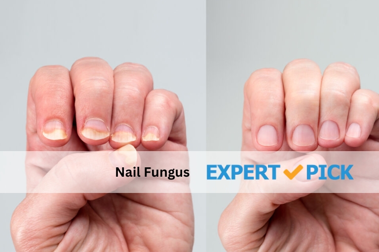 Nail-Fungus